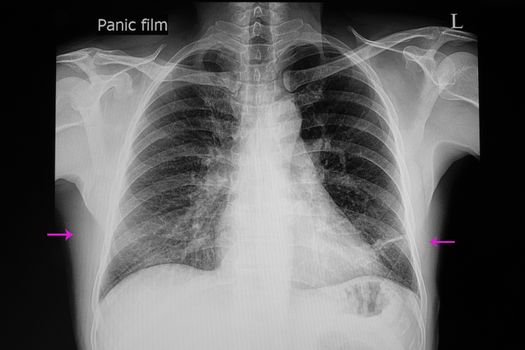 A chest xray film of a patient with right lower lung pneumonia and left lower lung plate atelectasi.