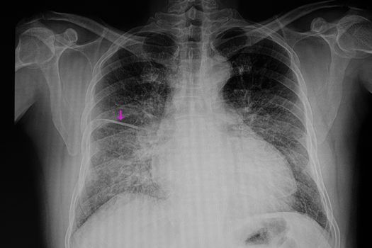 a chest xray film of a patient with cardiomegaly with congestive heart failure and pulmonary edema with fliuid in right lung fissure (arrow)