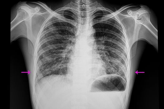 chest xray film of a patient with bilateral lower lungs pneumonia.
