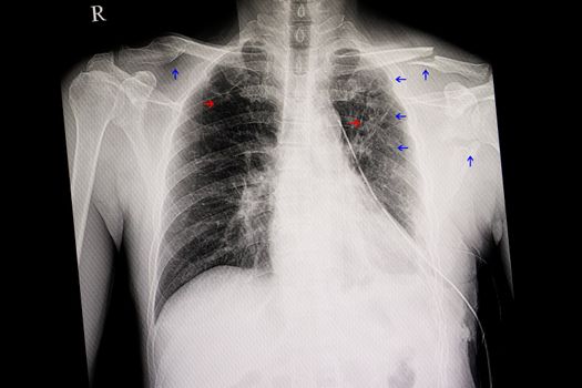 Cheat xray of a traumatic patient. Blue arrows show fracture left clavicle, scapular, posterior ribs, and old fracture right clavicle. Red arrows show reticular infiltrations in both lungs.