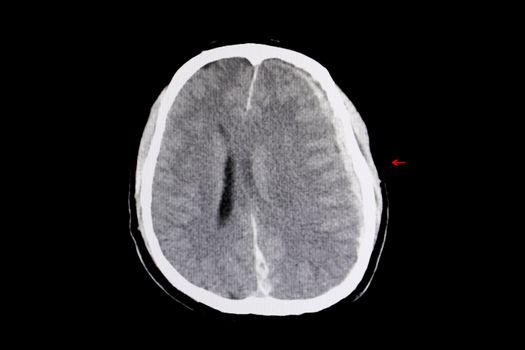 CT scan of a brain of a patient with subdural hemorrhage, interhemispheric hemorrhage and cerebral edema from trauamatic brain injury (TBI).