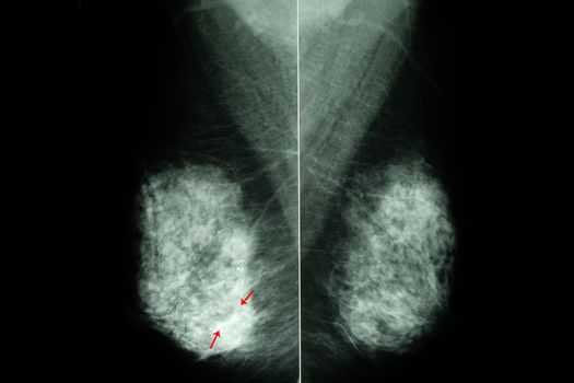an x-ray image of female breasts or mammogram shing a large nodule with cal calcium deposits in the breast tissue