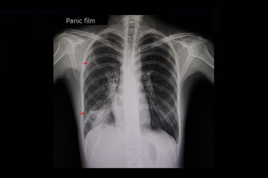 Xray film of a patient with active pulmonary tuberculosis in the right lung (red arrows).