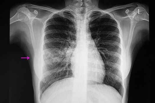 chest xray film of a patient with right middle lobe pneumonia.