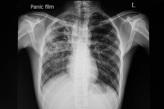 xray film of a patient with active pulmonary tuberculosis in the right upper lung