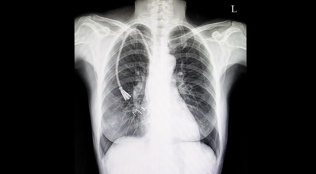 Chest xray film of a patient with double lumen catheter in his right superior venacava vein. Central line for hemodialysis.