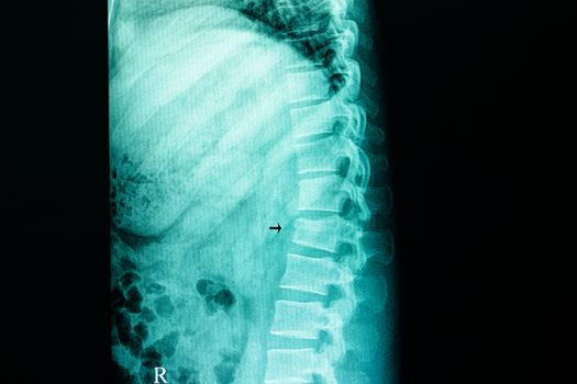 xray film of a patient with compression fracture on L1 lumbar spine after traumatic car accident