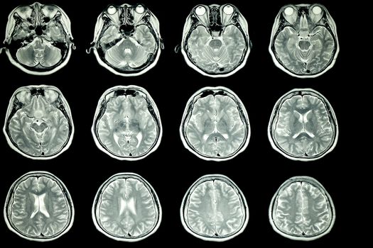 MRI scan of patient brain with normal signal intensity of the brain parenchyma