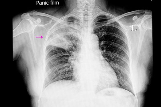 xray film of a patient with right lung lobar pneumonia