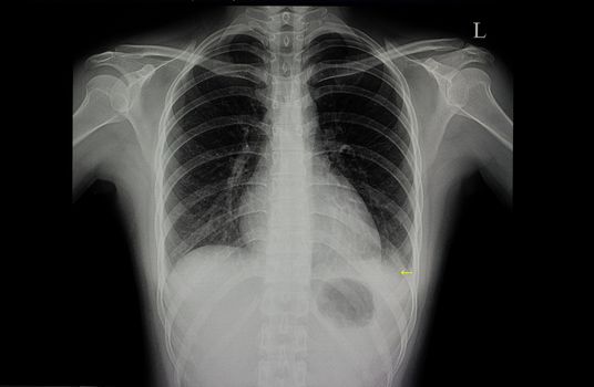 A chest xray film of a patient with left lower lung pneumonia.