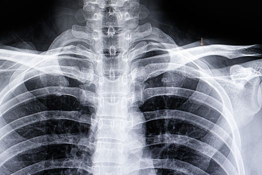 A chest xray film of a patient with car accident showing hairline fracture of left clavicle