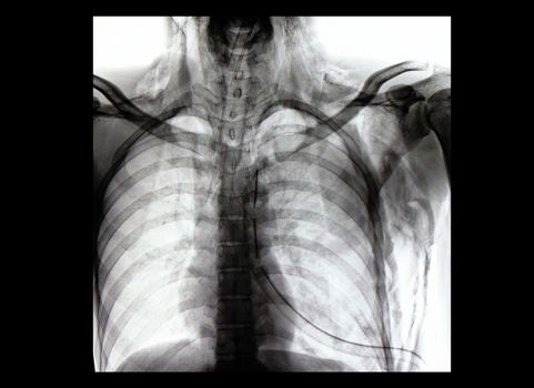 a reversed contrast chest film of a patient with chest and endotracheal tubes