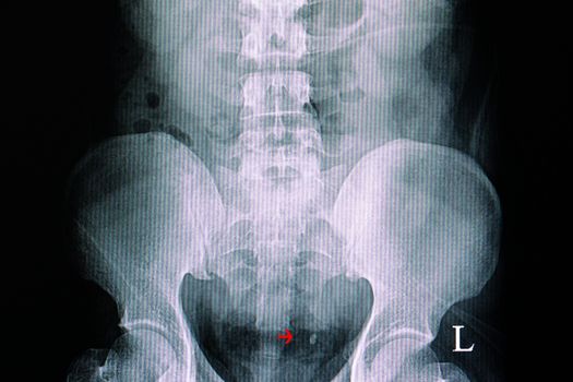 Xray film of a patient with left ureteric stone.