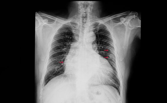 A chest xray film of a patient with cardiac enlargement or cardiomegaly with old multiple fractures of left ribs