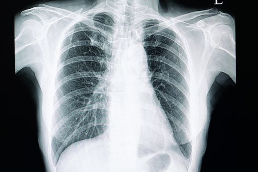 xray film of a patient with pulmonary tuberculosis with fibrosis in the right upper lung