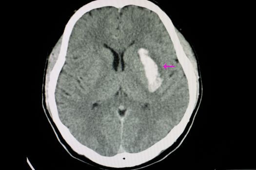 CT scan of a brain of a patient with intracerebral hemorrhage from stroke with bleeding in left internal capsule