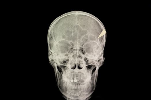 skull penetration injury with a tip of steel knife retained in the skull