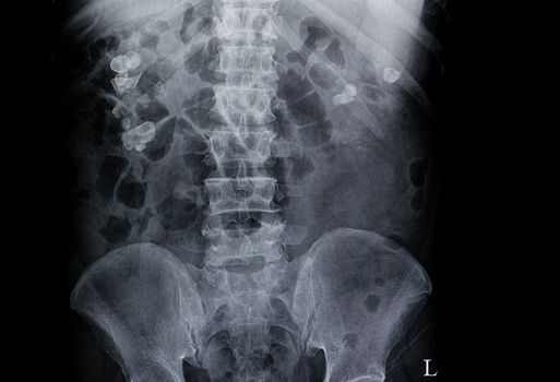 xray film of a patient with multiple kidney stones in both kidneys