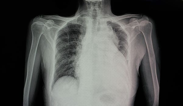 a chest x-ray film of a patient with cardiomegaly with left side heart failure, pulmonary edema, and pericadial effusion