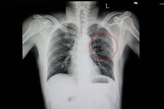 a chest x-ray of a blunt chest wall injuried patient showing fractured ribs 5, 6, 7, 8 on the left side(red cycle) with some pulmonary contusion
