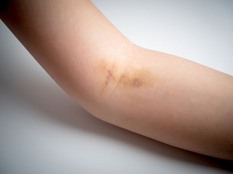 bruises on woman arm skin
