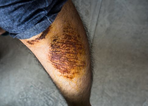 Man with large scab wound on his left leg close up shot