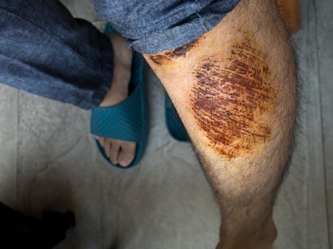 Man with scab wound on his  leg from accident close up shot