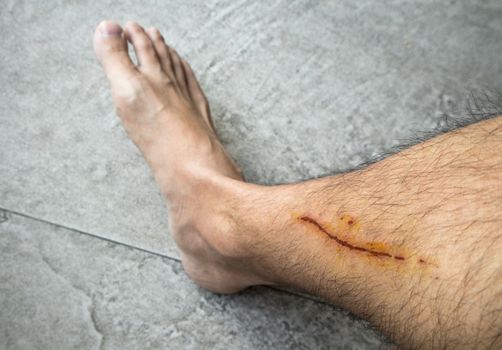 Man with long scab wound on his right leg close up shot bare foot