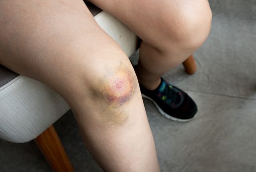 Woman with Bruise on knee from falling accident close up shot