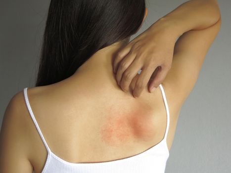Health allergy skin care problem. Closeup young woman scratching her itchy back with allergy rash