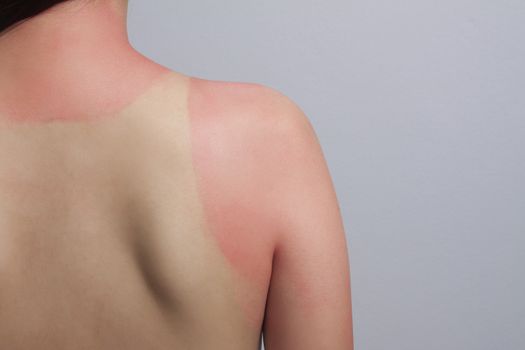 sunburn. red skin is around the shirt, effect from sunburn.