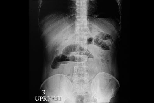 Abdominal xray film of a patient with bowel obstruction, upright position.