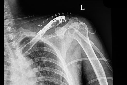 A shouder film xray of a traumatic patient with fractured left clavicle after plate and screw fixation.