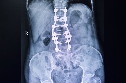 Xray film of a back of a patient who had spinal surgery showing spinal defects from laminectomy at L2-L5 which were fixed with metallic orthopedic device.