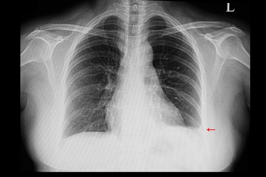 A chest xray film of a patient with minimal left pleural effusion.