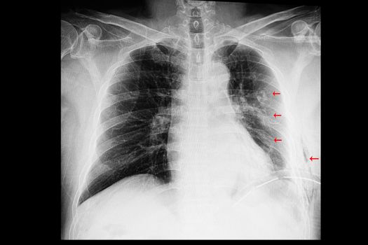 A chest xray film of a patient with old multiple left rib fractures with left side pleural effusion and an intrathoracic drainage tube (ICD). Left subcutaneous emphysema is also presented.