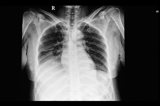 A chest xray film of a patient with pulmonary edema, cephalizaion, and pleural effusions. of both lungs. A right heart venous catheter is also shown.