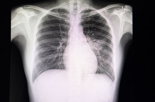 A chest xray film of a patient with pneumonia or pneumonitis. The patient has alveolar infiltration in the left middle lungs. Pulmonary tuberculosis is also considered.