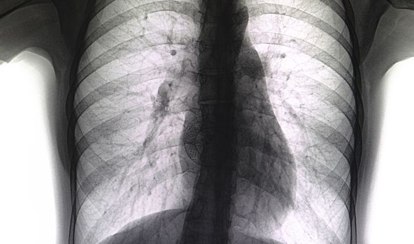 A reversed contrast chest xray of a patient with a stent implantation for atrial septal defect. A circular stainless steel ASD implant is seen across the atrial septal. An effectve treatment of ASD.