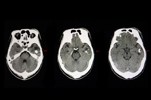 A CT brain with radiopaque material injected. A large cyctic tumor with internal enhancing lesions is shown in the left temporal lobe. CT scan of a malignant brain cancer.