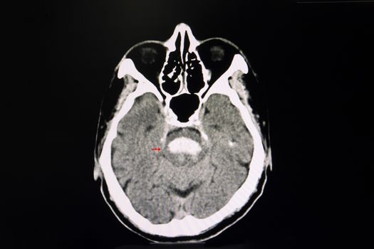 A CT brain of a patient with aucte hemorrhagic stroke.