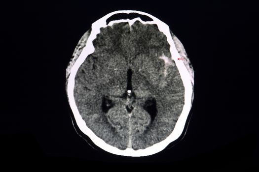 Ruptured cerebral aneurysm. A CT brain scan of a patient with subarachnoid hemorrhage in left basal cistern from ruptured cerebral cavernous aneurysm. Hemorrhagic stroke.