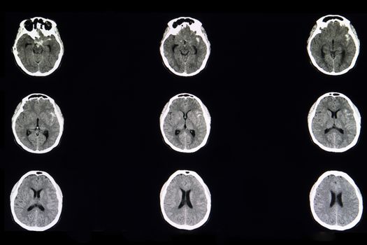 A CT brain scan of a patient with subarachnoid hemorrhage in left basal cistern from ruptured cerebral cavernous aneurysm. Hemorrhagic stroke.