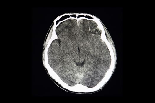 A CT brain scan of a traumatic patient with bilateral frontal-laterral hemorrhagic contusion with evidence of likquifaction of blaad. Also, there is minimal subrachnoid hemorrhage in the skull base.