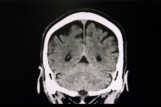 CT scan of the brain of a patient suffers from acute stroke showing moderate brain atrophy. Coronal section.