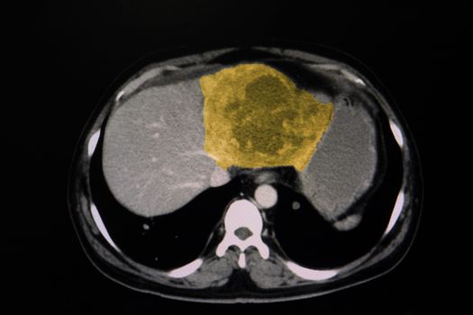 CT scan of the liver of a patient showing a large liver mass (demonstrated as color enhanced image). A hapatocellular carcinoma or hepatoma was diagnosed).