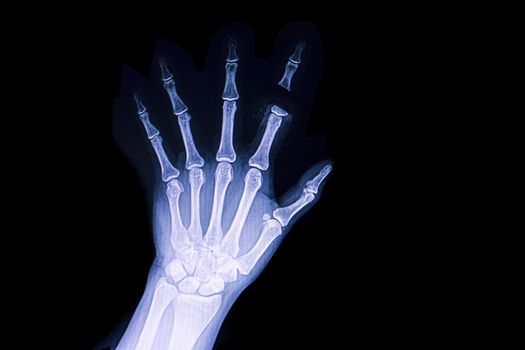 A hand x ray film of a patient with traumatic amputation of his index finger.