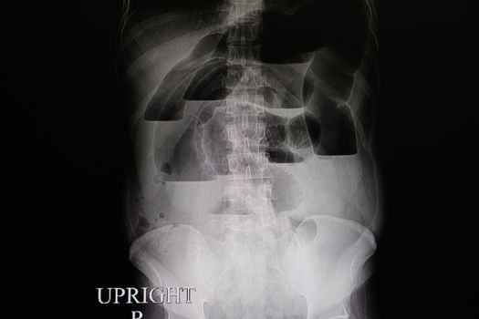 an abdominal xray film of a patient with complete large intestinal obstruction, shown with fluid and air in loops of large and small bowels