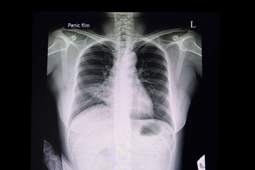 A chest xray film of a patient with pneumonia in his right middle lung. A case of abnormal x ray. Bacterial infection suspected.