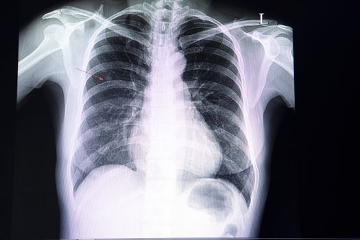 A chest xray film of a patient with a small nodule in his right upper lung. A case of abnormal x ray. Pulmonary tumor suspected.